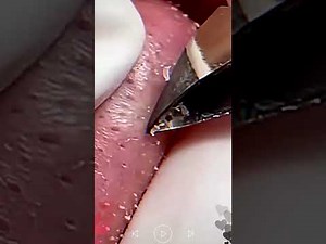 Skincare | Blackheads Removal #313 #tweezers skincare #blackheads blackheads