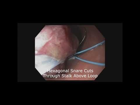 Endoscopic loop to Aid in Pedunculated Polyp Removal