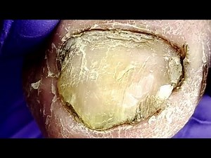 Bacteria infected the entire nail, professionally trimmed with a lotion【Doctor Liu Pedicure】