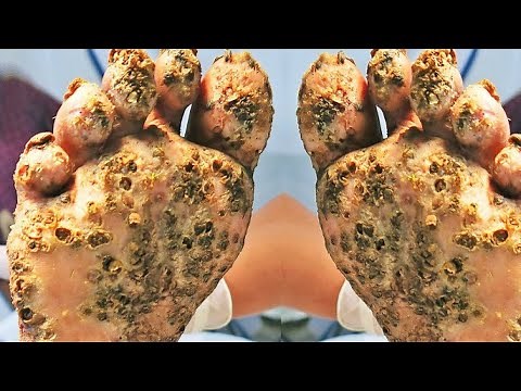 TREATMENT OF JIGGERS