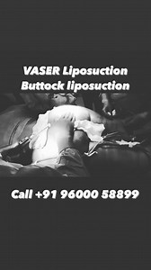 Buttock Liposuction 🍑 - VASER Technique : Buttock is one of the common area where fat gets accumulated very easily. The process removes excess fat in certain areas of the buttock to achieve maximum contouring. #liposuction #vaserliposuction #butt #buttockliposuction #buttlipo #bbl #fatreduction #fatremoval #fat #powerassistedliposuction #boardcertifiedplasticsurgeon #todaypost #motivation #wednesdaywisdom Book a consultation today ❗️ ☎️ Call: 91 96000 58899 🌐 Visit: www.thecosmeticsurgery.org 