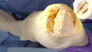 ATTUNE® Revision Fixed Bearing Knee System - Tibial Short Cemented Stem