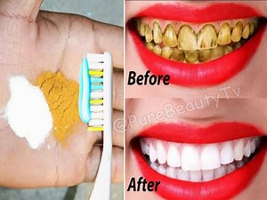 8K views · 302 reactions | Teeth whitening at home in 3 minutes || How to naturally whiten your yellow teeth || 100% effective | Pure Beauty Tv | Facebook