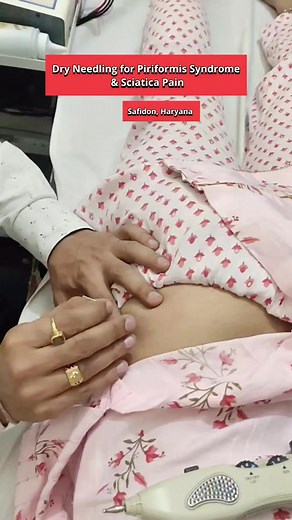 Dry Needling for Piriformis Syndrome & Sciatica Pain #Sciatica #backpain #piriformissyndrome #slipdisc #dryneedling #health | Healing osteopathy, chiropractic and physiotherapy clinic