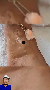 148K views · 576 reactions | Pensó que era un virus contagioso y se sacó una bolita del pie pero los doctores le dijieron otra cosa ..️ #fyfpシ゚ #amor #fightcoronavirus #covid19UK #fblifestyle #gym | Jorge Franco | Facebook