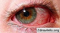 Симпатикова офталмия - Важно е да започнете лечението навреме, за да спасите окото 👃👃 Портал На Синусите И Др. - 2025