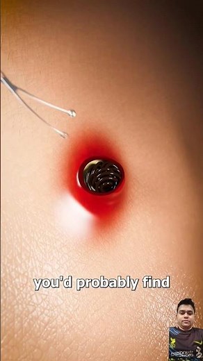 Pilonidal Cyst Uncovered Causes, Symptoms, and What’s Inside