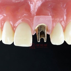 [Hot Item] Implantes dentales personalizados con pilar de titanio de aspecto natural del laboratorio dental Fromchina