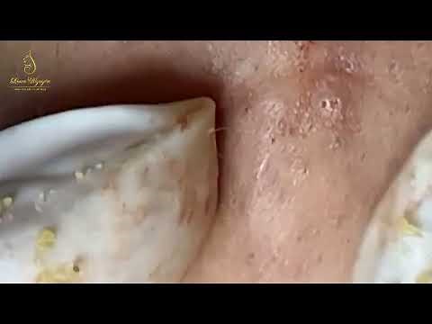 Loan Nguyen Acne Treatment 1651mh