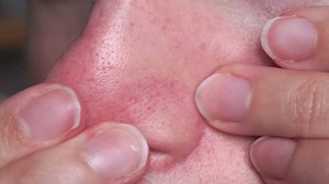 Close-up Blackhead Removal On Nose Realistic Stock Footage Video (100% Royalty-free) 3846209667 | Shutterstock