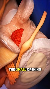 85K views · 608 reactions | How Endoscopic Spinal Surgery Is Done | Donnallyspineconsult | Facebook