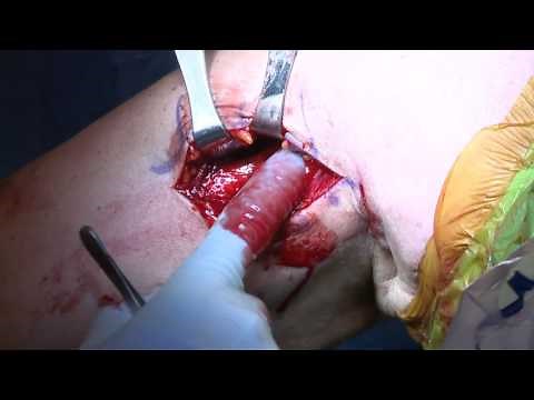 Biceps Tenodesis Surgery Technique | Colorado Shoulder Specialist