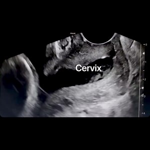 Incompetent cervix before and after cerclage case by @doc.lavalle | John Z Wetmore