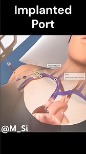 Implanted Port