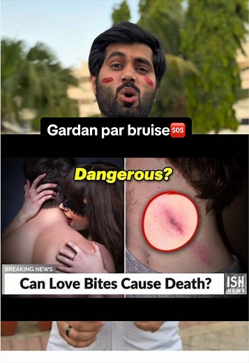 How to Get Rid of a Hickey Fast