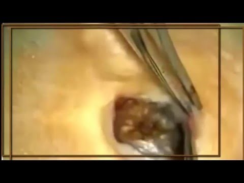 Blackhead Removal - EW! Disgusting Blackheads! Pt. 1