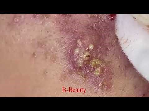 Pimple Removal and Acnes Treatment / B-Beauty /#07