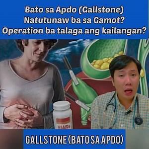 Bato sa Apdo (Gallstone) Natutunaw ba talaga sa Gamot? | Payo ni Doc Vitto