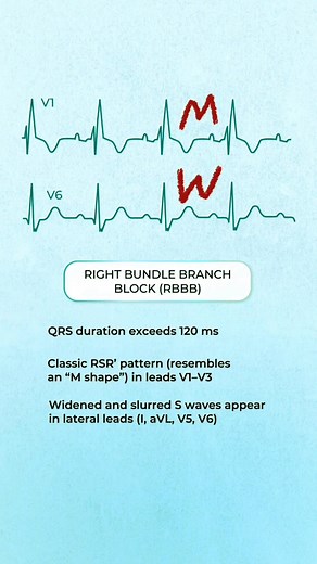 33K views · 307 reactions | Intraventricular conduction delay (IVCD)...