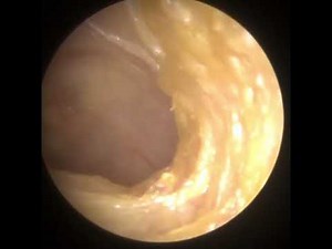 812 - Glue Ear Dead Skin Peel Ear Wax Removal