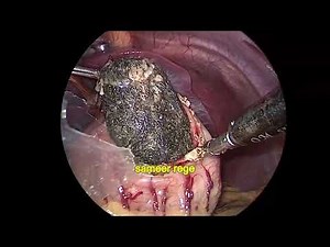 Laparoscopic gastric trichobezoar removal