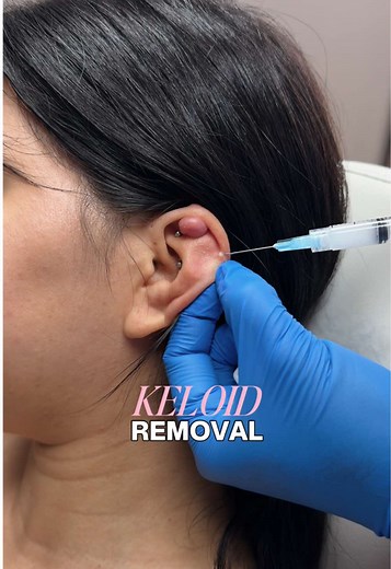 Keloid Treatment: Effective Ear Enhancement Techniques
