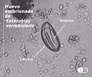 ➡ La enterobiosis u oxiuriosis es una helmintiasis producida por Enterobius vermicularis, nemátodo de amplia distribución mundial, presente en todos los climas, niveles sociales y económicos de la población; afecta mayormente a los niños 1-3 años. La transmisión es de persona a persona por la ingestión de los huevos del parásito (xenohelminto); las larvas se incuban en el intestino delgado y luego maduran en el colon. La hembra grávida migra hacia el área anal, sobre todo en la noche, liberando 