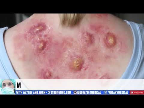 Carbuncle, Carbuncles and Furuncles!