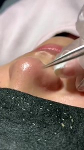 11K views · 67 reactions | Comédons c'est quelque chose aussi hein......... Excès de sébum #Autre_technique_extraction_de_comedon | Chicmadam Chic Cosmétique | Facebook