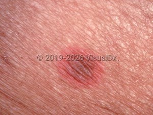 VisualDx - Fixed drug eruption