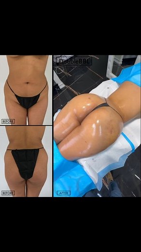 Goals Plastic Surgery on Instagram: "Skinny DoubleBBL for BMI 23 by Dr Ansari, Goals NY"
