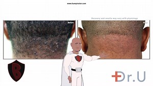 It is my pleasure to present one of my patients who suffered a serious skin condition known as Acne Kelodlais Nuchae (AKN). This patient of mine sought help from me because his AKN started to affect his self-esteem and began to discomfort as time passed by. In order to meet my patient’s desires, I performed a surgical procedure to get rid of the AKN permanently. After undergoing an AKN surgical procedure, he has not felt comfort and confidence like ever before. Helping my clients achieve a natur