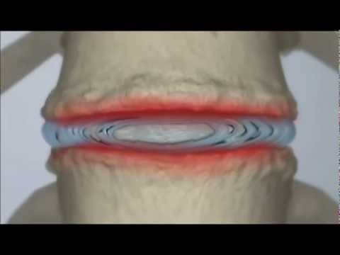 How to treat Back Pain