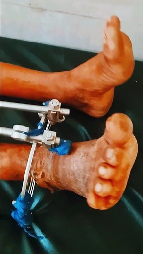 Open Fracture of Distal Tibia- Fibula treated surgically with External Fixation 😍| CompoundFracture