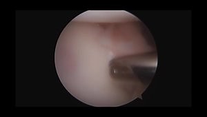 Arthroscopic Bankart Repair in a Lateral Decubitus Position