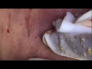 Deep Cystic Acne Extraction You Can’t Look Away From | Pimple Spa