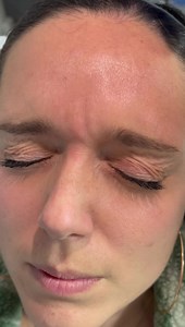 1.4K views · 40 reactions | Mini Botox aprovechen la promo por fiestas patrias | Dr. Jean Paul Osores | Facebook