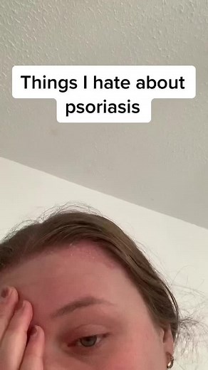 Things I hate about having psoriasis! #psoriasisawareness #psoriasis #beautiful_psoriasis