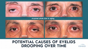 What Can Cause Drooping Eyelids in Adults