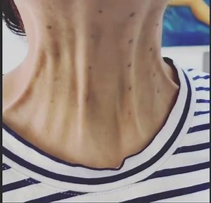 The Aging Neck !#treat the muscles before its too late ⏰ start early to prevent sagging of the neck #necklift#agingneck#woman#antiaging #botox#fillers#peptides#rf#skin#nonsurgical#musthave BOOK UR SESSION NOW CALL  03958018 | Carole Zamroud - Z. Clinic Beirut/Dubai | Facebook