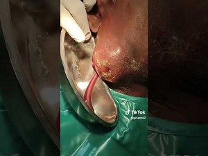 Extraoral Drainage of Submandibular Abscess - Odontogenic Infections