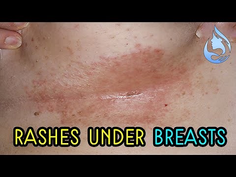 Home remedies to treat the rashes under the breasts