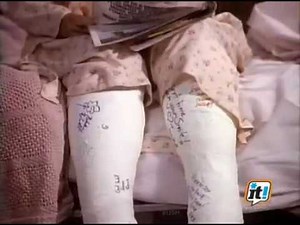 Both legs casted