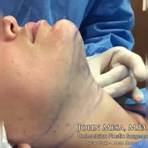 4.9K views · 26 reactions | Chin Liposuction Under Wide Awake Local...