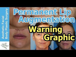 Warning Graphic: Permanent Silicone Lip Augmentation Live Video Demo