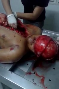 BODY BEING EXAMINED AT AUTOPSY