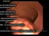 TransAnal Minimally İnvasive Surgery (TAMIS) for T1 Malignant Adenoma of the Proximal Rectum  • Video • MEDtube.net