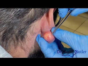 Removal of an epidermal cyst on the earlobe