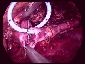 Retroperitoneoscopic Dismembered Pyeloplasty For Ureteropelvic Junction Obstruction