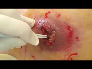 Abcess Drain